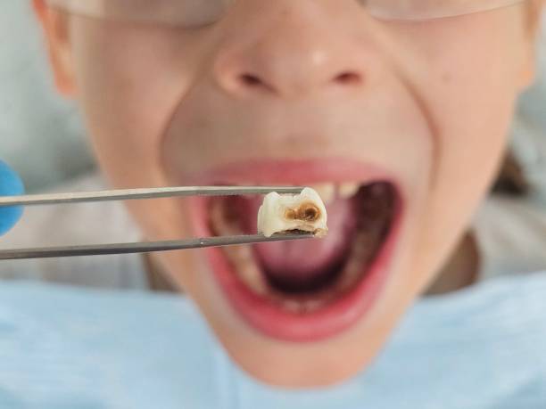 Best Emergency Treatment for Dental Infections or Abscesses in Frankl, IN